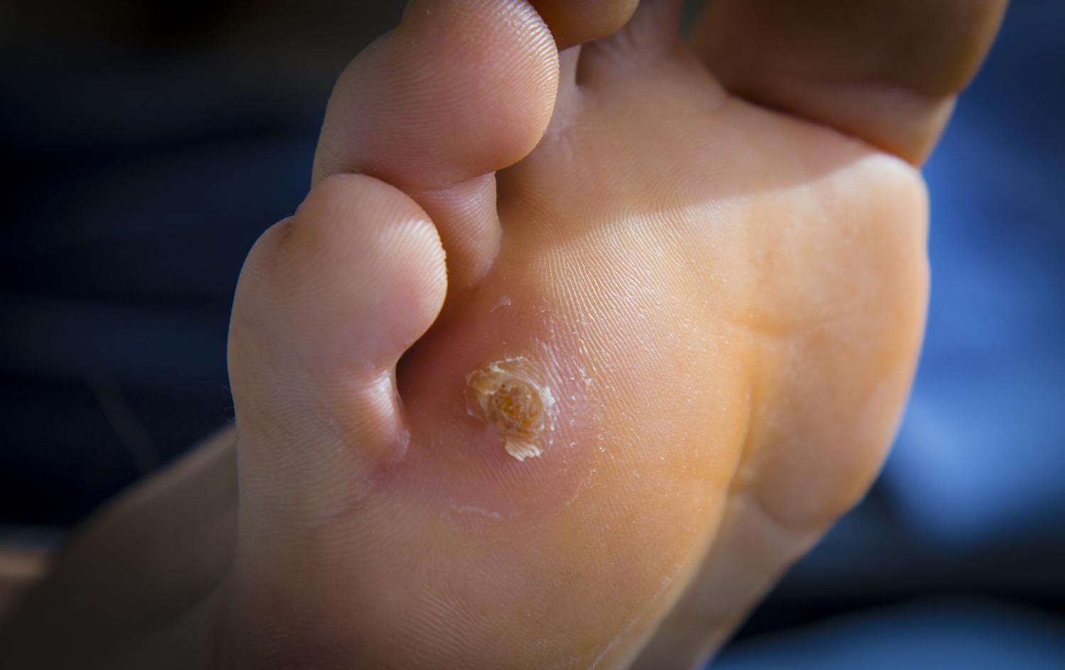 Pied diabetique - soins des pied