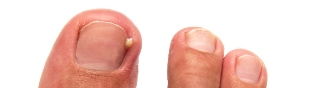 Service de Prévention et Correction des Ongles Incarnés