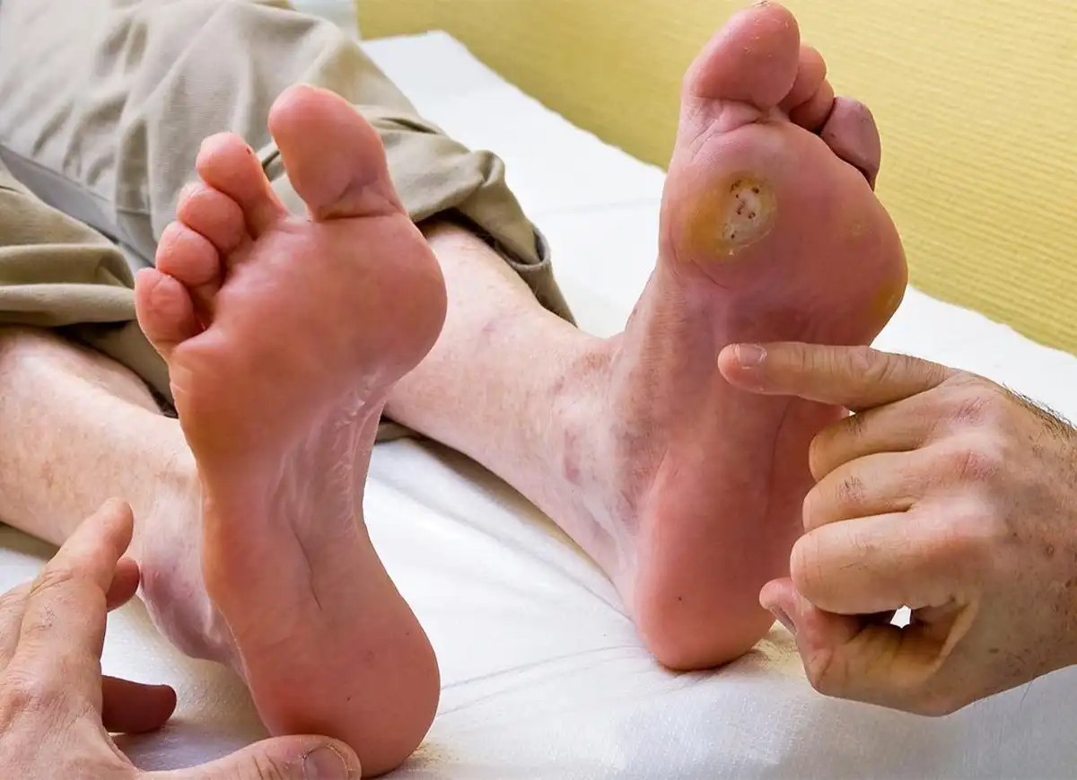 soins des pieds diabétique à Montréal