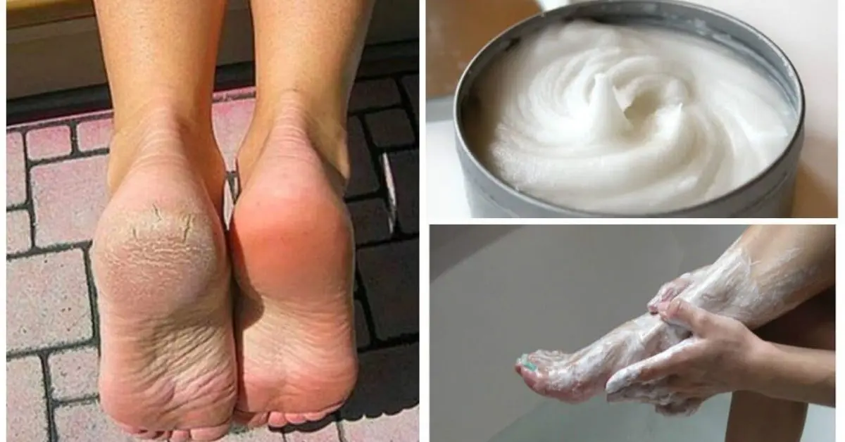 Amincissement des cors et callosités Amincissement des cors et callosités des pieds avant et après